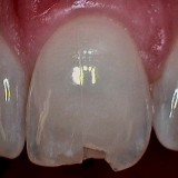 Chipped Teeth