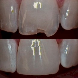 Chipped Teeth