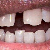 Gaps
