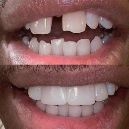 Gaps