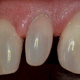 Peg Lateral