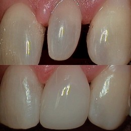 Peg Lateral