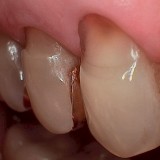 Root abrasions