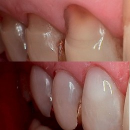 Root Abrasions