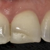 Veneers