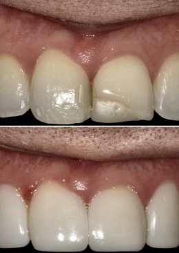 Veneers