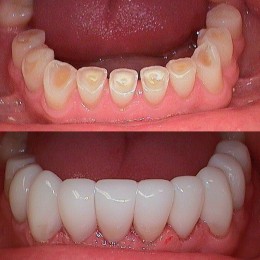 Worn Teeth