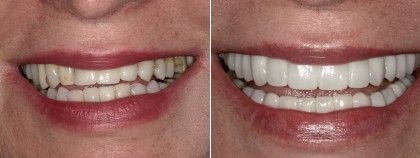 Smile 25