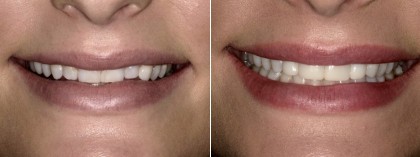 Smile 30